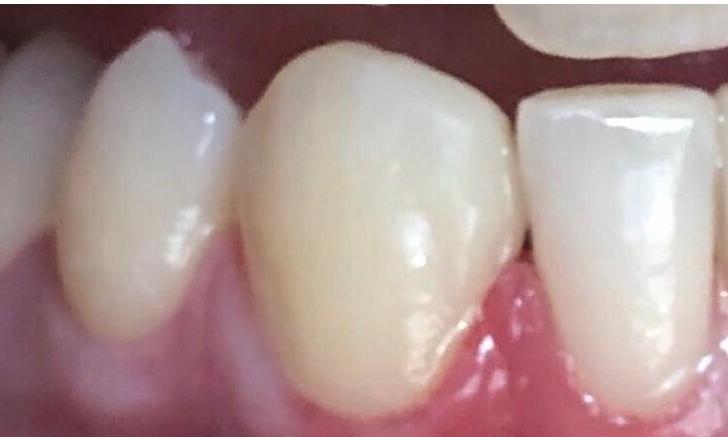 Cosmetic-Dental-Bonding-After-Image
