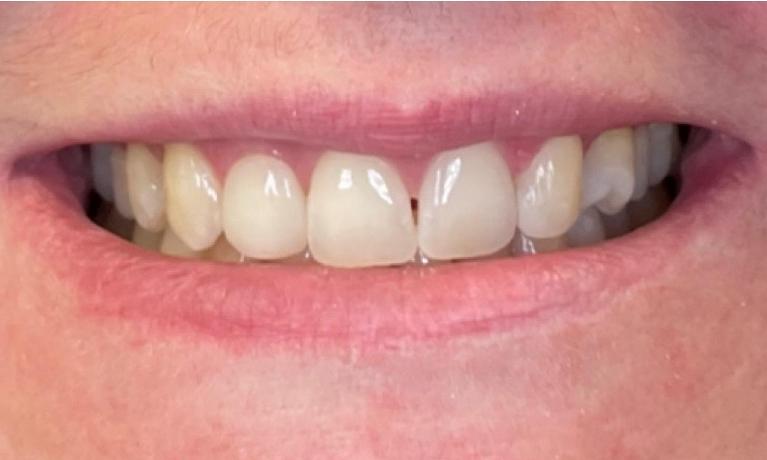 Cosmetic-Dental-Bonding-After-Image
