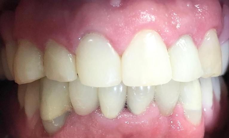 Decay-Removal-White-Fillings-Porcelain-Crowns-Partial-Dentures-After-Image