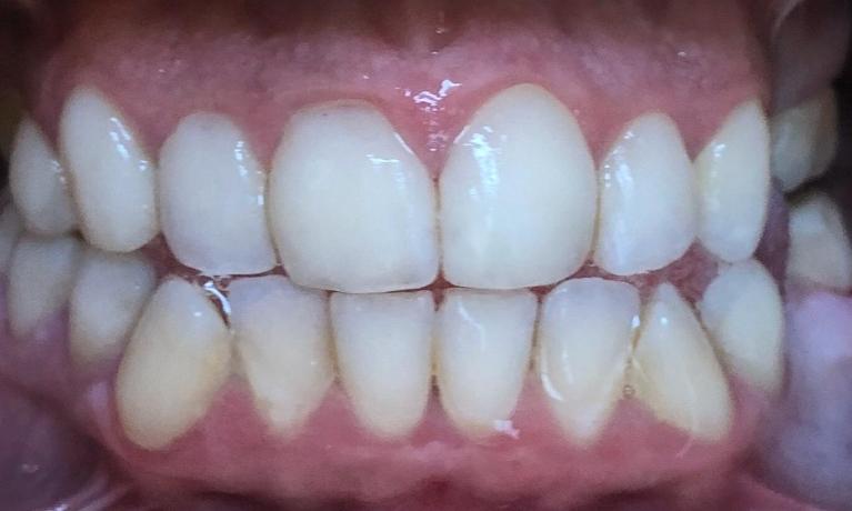 Decay-Removal-White-Fillings-Porcelain-Crowns-After-Image
