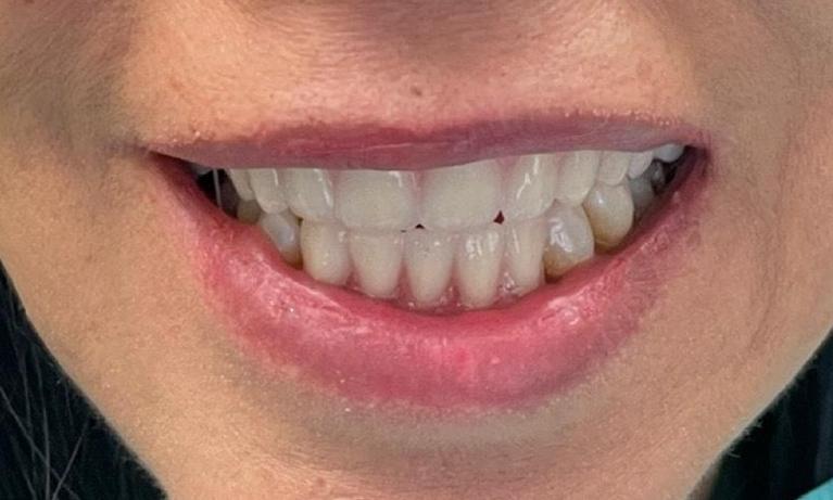 Smile-Makeover-Porcelain-Crowns-Veneers-Fillings-Extractions-Partial-Dentures-After-Image