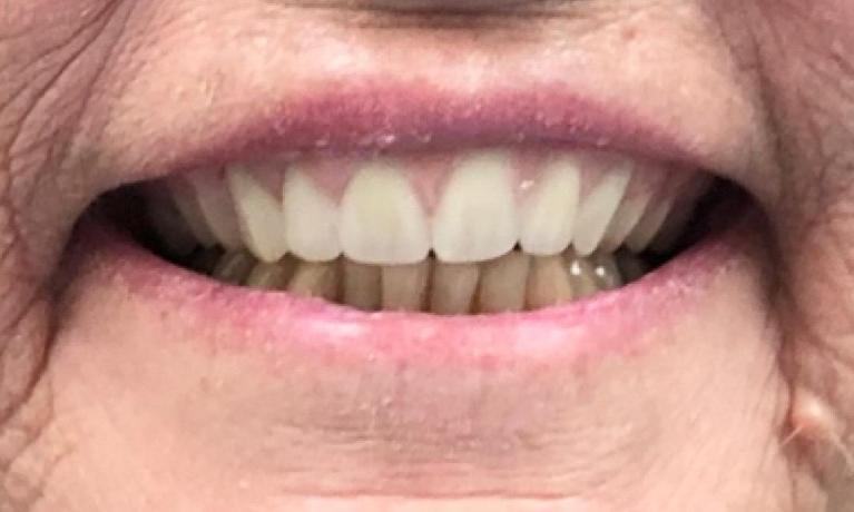 Top-Extractions-and-Dentures-After-Image