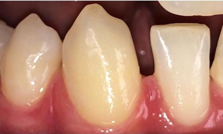Cosmetic-Dental-Bonding-Before-Image