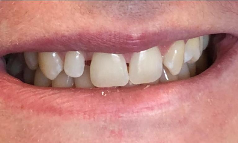 Cosmetic-Dental-Bonding-Before-Image