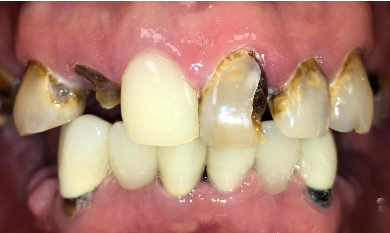 Decay-Removal-White-Fillings-Porcelain-Crowns-Partial-Dentures-Before-Image