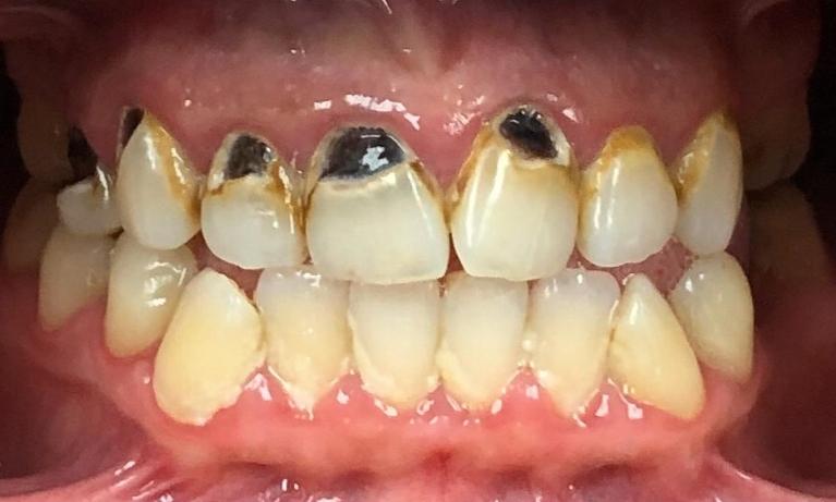 Decay-Removal-White-Fillings-Porcelain-Crowns-Before-Image