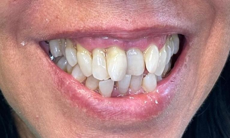Smile-Makeover-Porcelain-Crowns-Veneers-Fillings-Extractions-Partial-Dentures-Before-Image