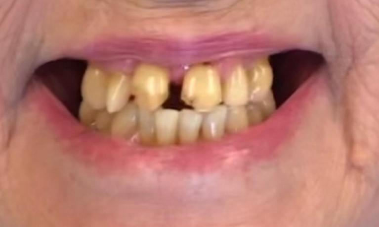 Top-Extractions-and-Dentures-Before-Image
